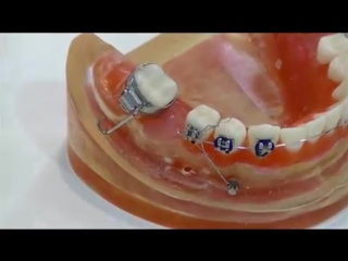 porn dr mazor yoav molar masialization power arm mini screw ортодонтия израильский ролик hd