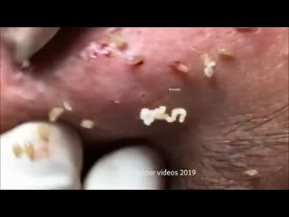 porn воспаленные прыщи корочки черные точки hd