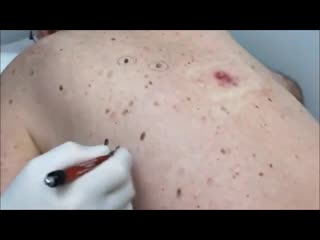 porn удаление огромных черных точек на спине hd