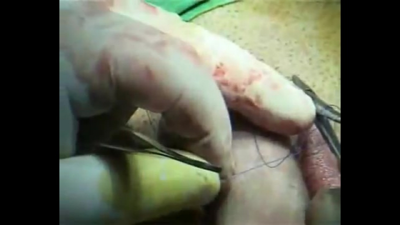 porn хирургические методы увеличения члена hd