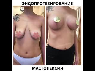 porn эндопротезирование молочных желез и мастопексия hd