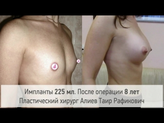 porn увеличение груди через 18 лет результат операции хирург алиев таир рафикович hd