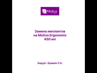 porn результат вторичной маммопластики и замены имплантов на motiva ergonomix hd