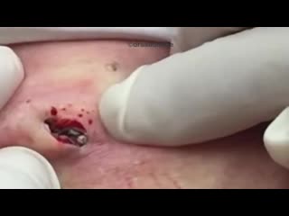 porn расширенные поры винера или черные точки hd