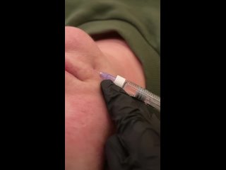 porn биоревитализация препаратом novacutan эффективное омоложение процедура для глубокого увлажнения и восстановления кожи hd