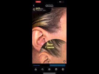 porn видео от трихопигментация рубцы имитация ареол томск hd