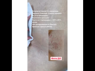 porn видео от лазерная эпиляция массаж косметология ижевск hd