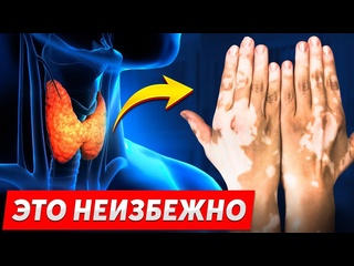 porn что такое витилиго как правильно лечить белые пятна hd