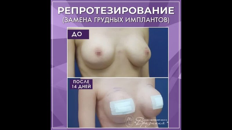 porn замена грудных имплантов оперировал суров и а mp4 hd