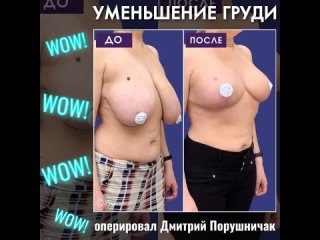 porn уменьшение груди при гигантомастии оперировал дмитрий порушничак mp4 hd