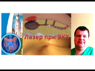 porn лазерная операция эпителиальный копчиковый ход киста копчика экх пилонидальная болезнь hd