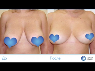 porn до и после редукционная маммопластика выполнена в клинике doctorplastic hd
