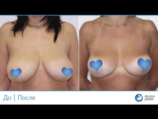 porn до и после редукционная маммопластика выполнена в клинике doctorplastic hd