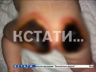 porn жуткий ожог получил грудной ребенок в нижегородской больнице а врачи вместо оказания помощи попытались все скрыть hd