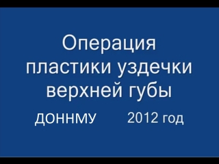 porn операция пластики уздечки верхней губы френулопластика при диастеме молодые стоматология hd