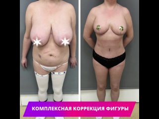 porn выполнена комплексная коррекция фигуры подтяжка и уменьшение груди липоабдоминопластика hd