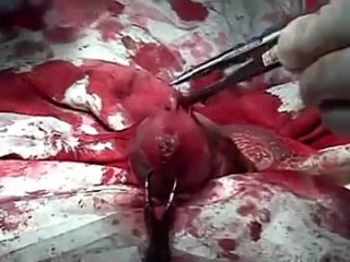 porn перелом полового члена хирургическое лечение болезни пейрони hd