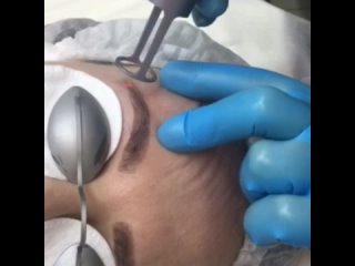 porn лазерное удаление бровей в афродите киров hd