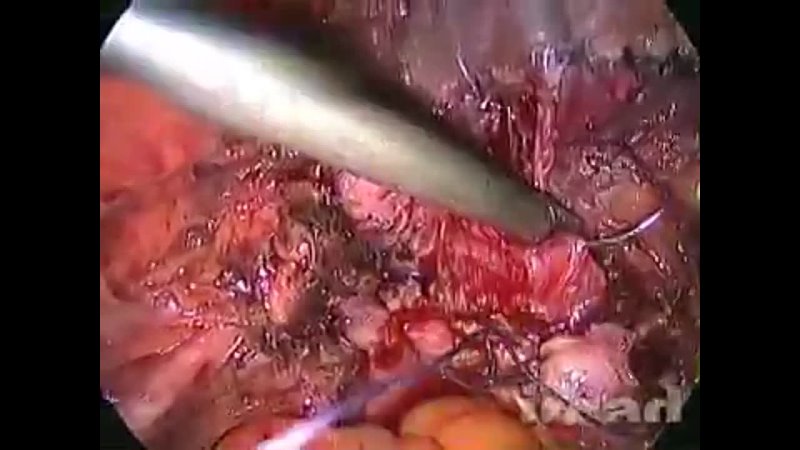 porn laparoscopic trachelectomy and partial cystectomy for the management of recurrent bladder endometriosis after hd