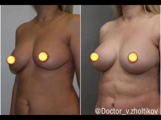 porn повторная маммопластика замена имплантов hd