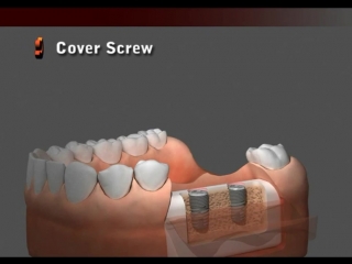 porn dentis implant cleanlant drilling sequence sole abutment hd