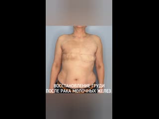 porn восстановление груди после рака молочных желез hd