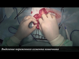 porn резекция и анастомоз кишечника у кота intestinal resection in cat hd